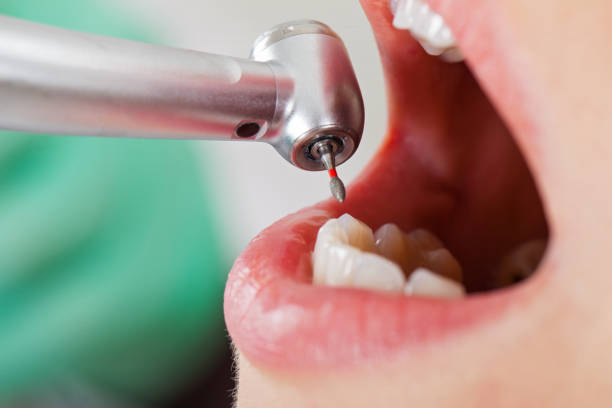 Best Knocked-Out Tooth (Avulsed Tooth) Treatment in Beverly, OH
